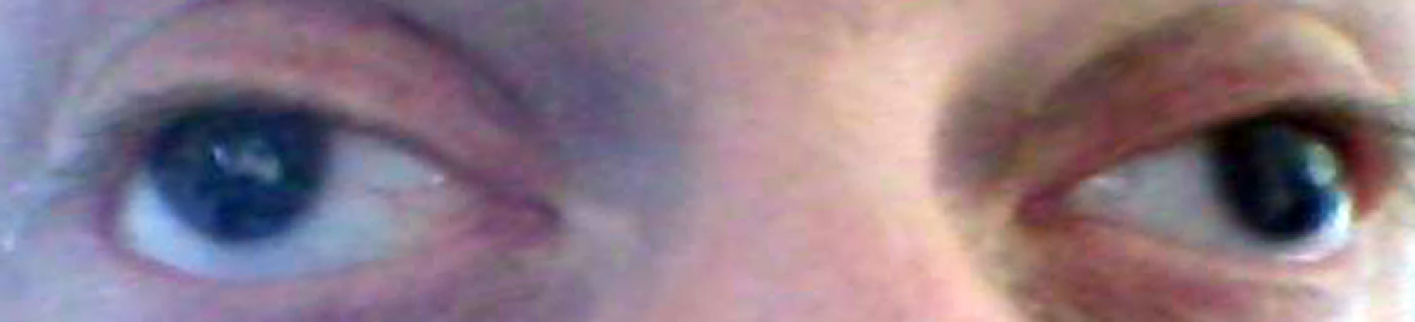 Eyes with aniridia - no irises